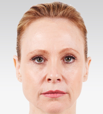 Injectable-Fillers-02 | Before Injectable Fillers