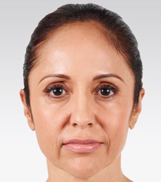 Injectable-Fillers-03 | Before Injectable Fillers
