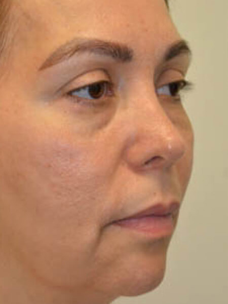 Injectable-Fillers-05 | Before Injectable Fillers 3