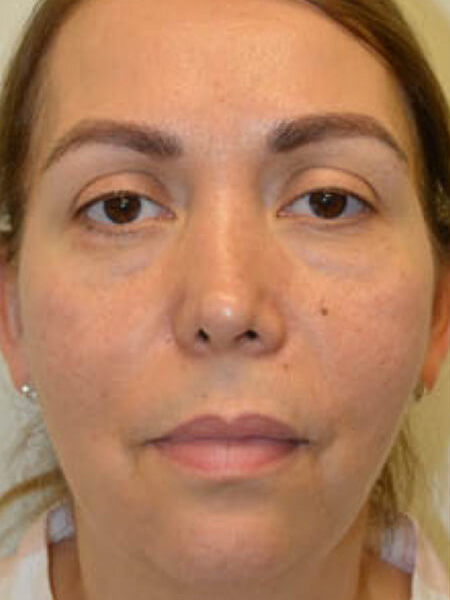 Injectable-Fillers-05 | Before Injectable Fillers