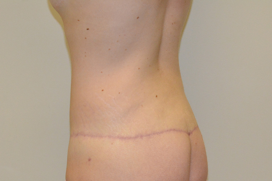 Body-Lift-01 | After Body Lift 2