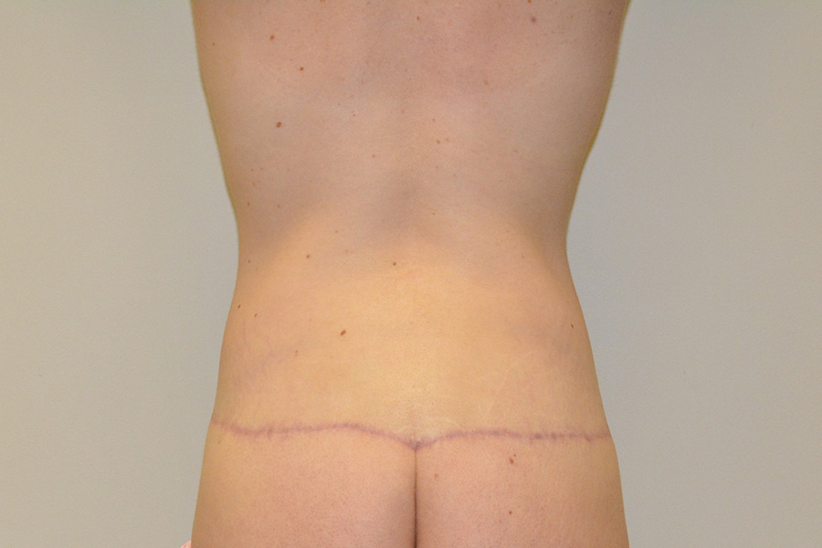Body-Lift-01 | After Body Lift 5