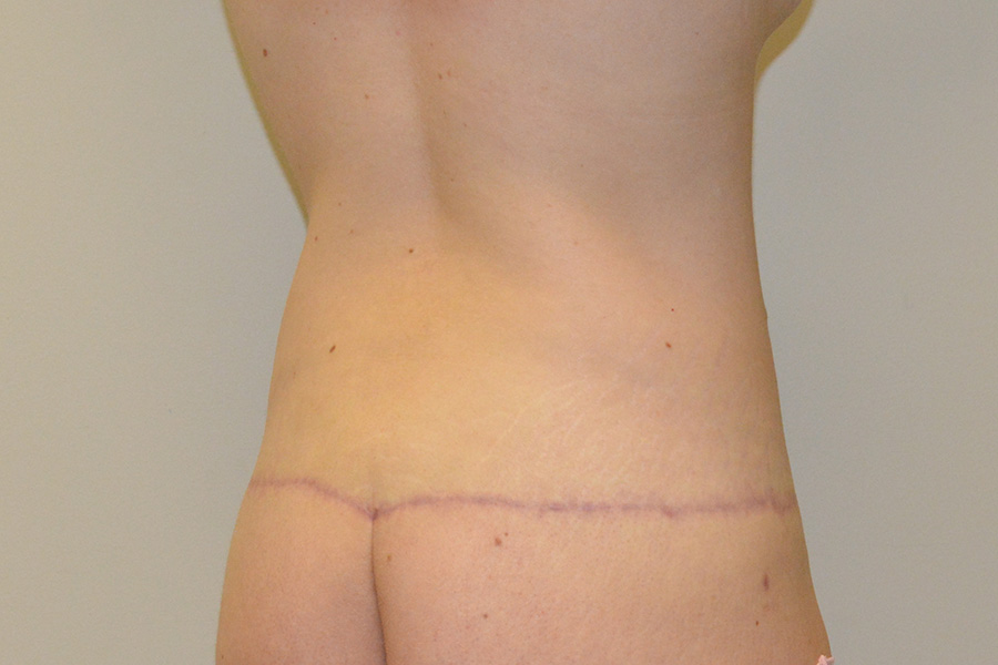 Body-Lift-01 | After Body Lift 6