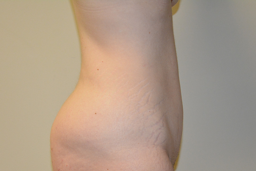 Body-Lift-01 | Before Body Lift 7