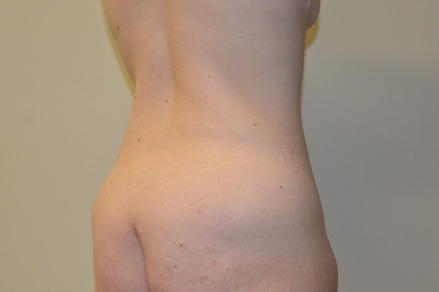 Body-Lift-01 | Before Body Lift 6