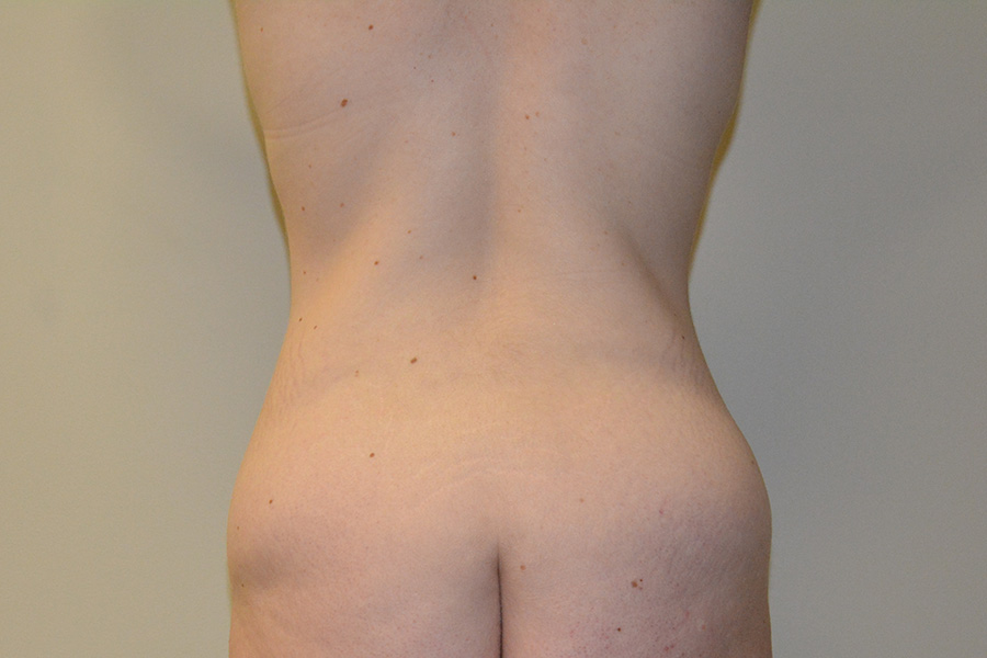 Body-Lift-01 | Before Body Lift 5