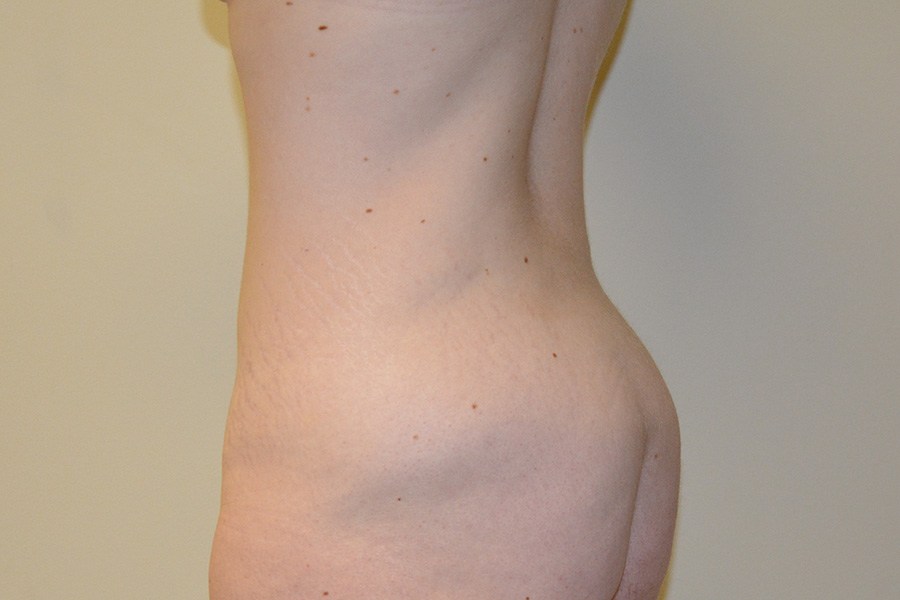Body-Lift-01 | Before Body Lift 2