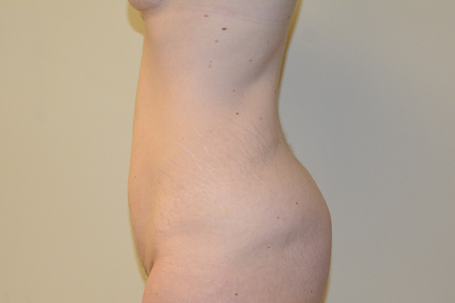 Body-Lift-01 | Before Body Lift 3